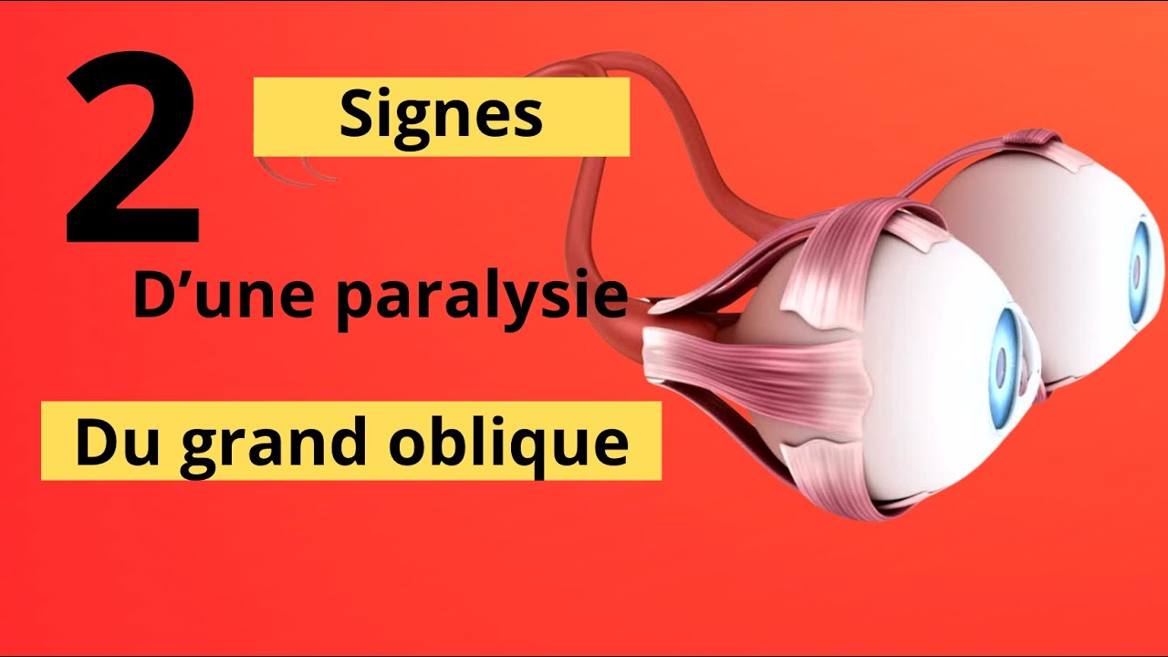 Diplopie verticale (vision double) : Et si c'était le muscle grand oblique ? (= L'oblique supérieur)