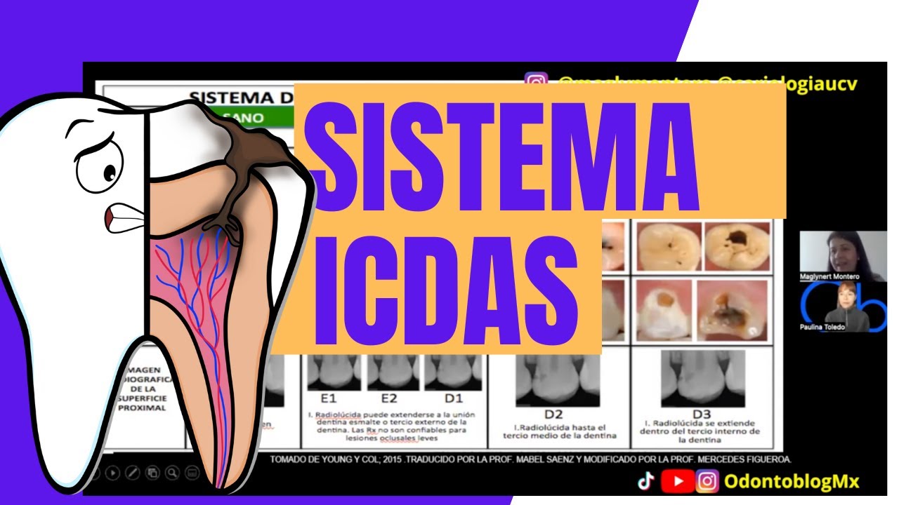 SISTEMA ICDAS - ICCMS 🦷 para la Clasificación de Caries Dentales con Dra Maglynert Montero Baptista