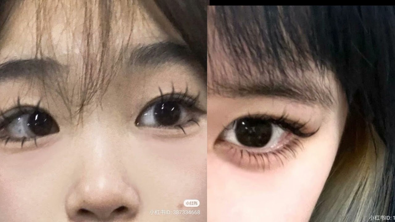 Flat eyelids and low eyelid crease