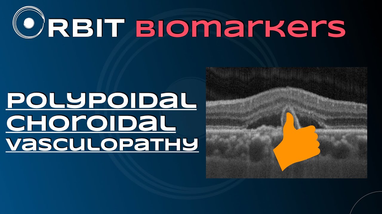 Orbit - Biomarkers - Vasculopatia Polipoidal da Coroide