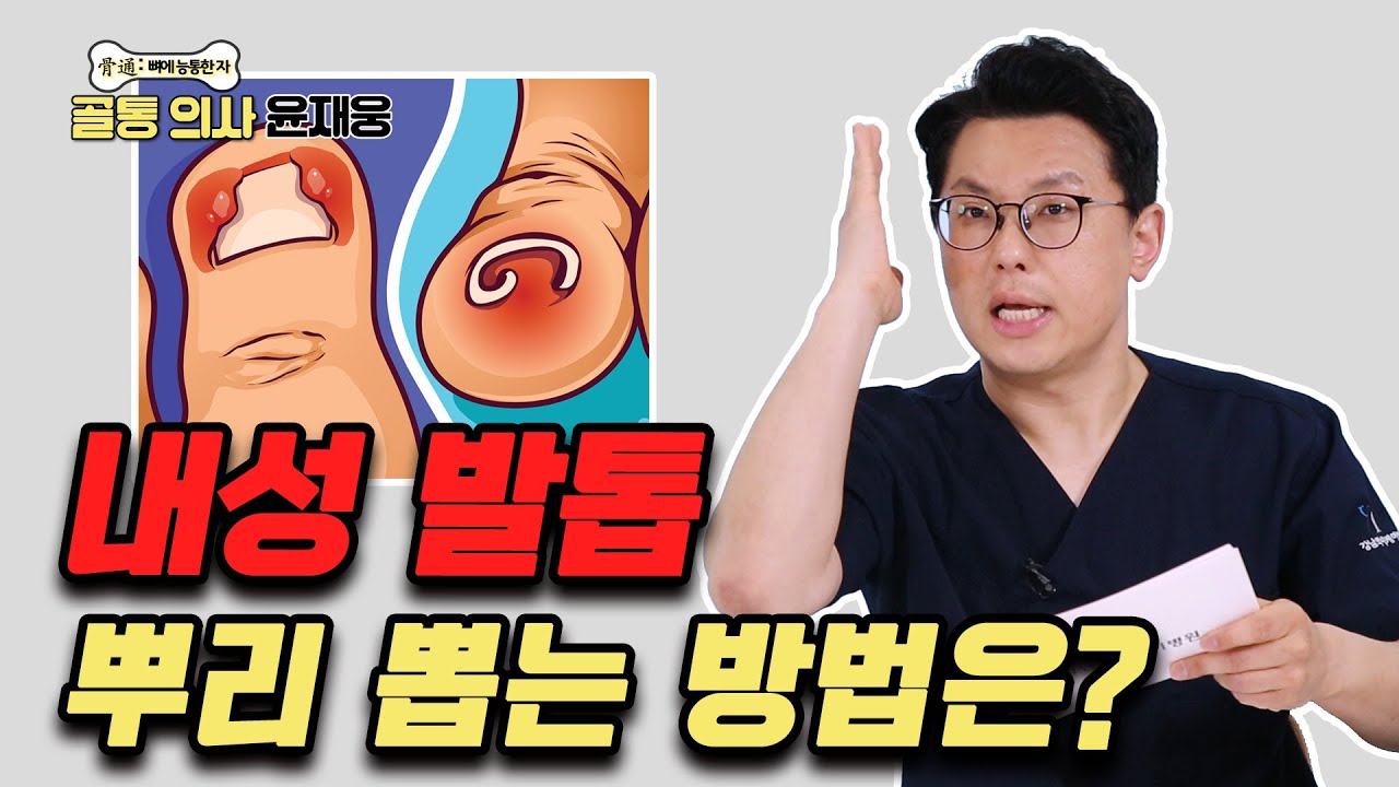 자꾸 재발하는 ‘내성 발톱’ 이렇게 치료하세요! - 골통 의사 윤재웅 #69 내성발톱