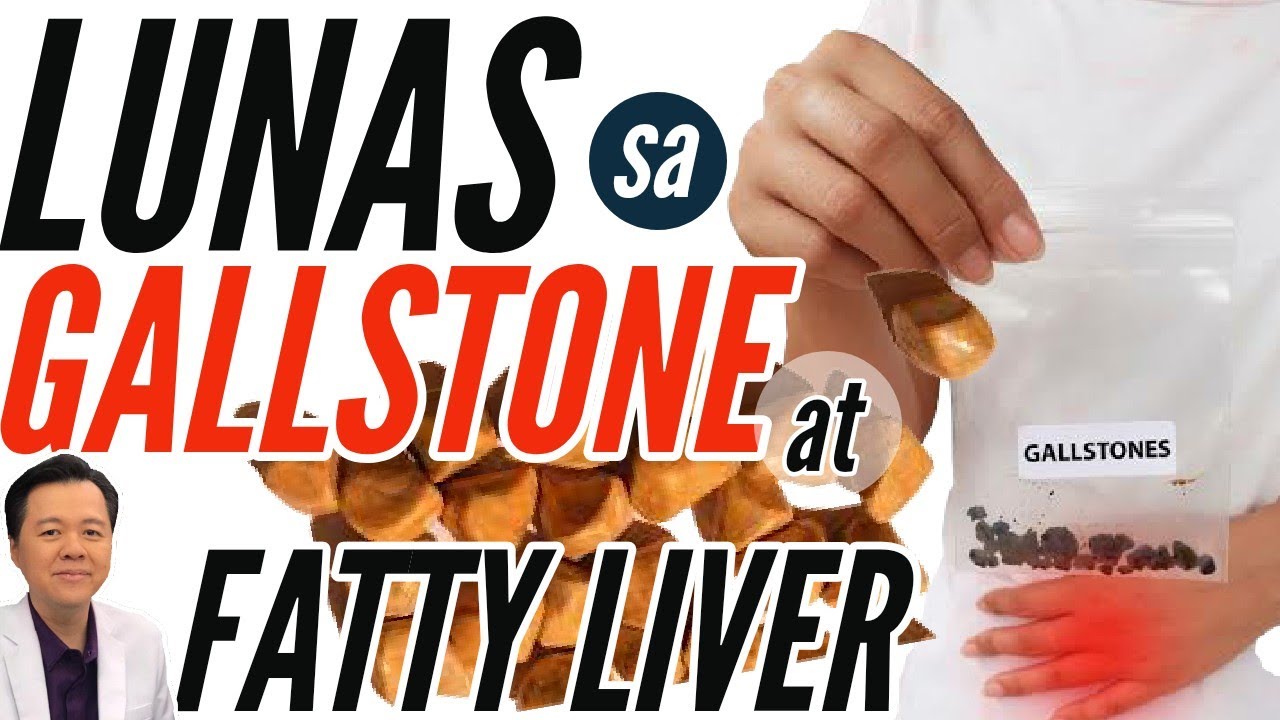 Lunas sa Gallstone at Fatty Liver- Payo ni Doc Willie Ong #8