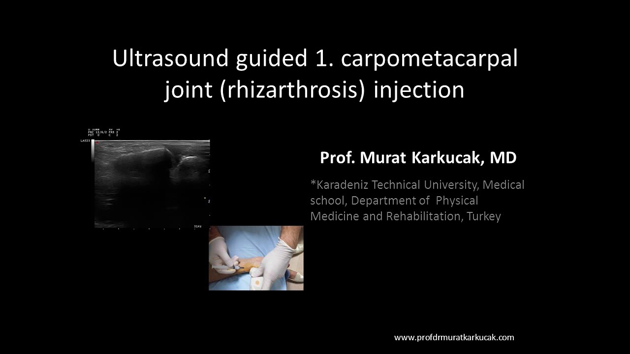 Ultrasound guided 1  carpometacarpal joint rhizarthrosis injection, by Prof Murat Karkucak MD
