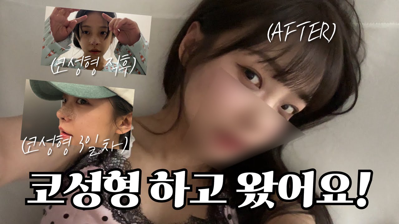 코성형 하고 왔어요! 전후 후기!