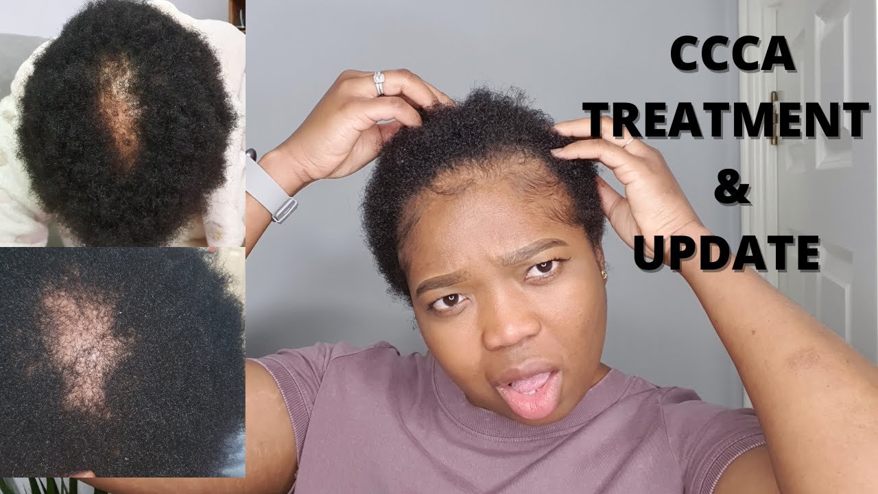 MY HAIR LOSS JOURNEY PART 2 || HOW TO TREAT THE SYMPTOMS OF CCCA ALOPECIA