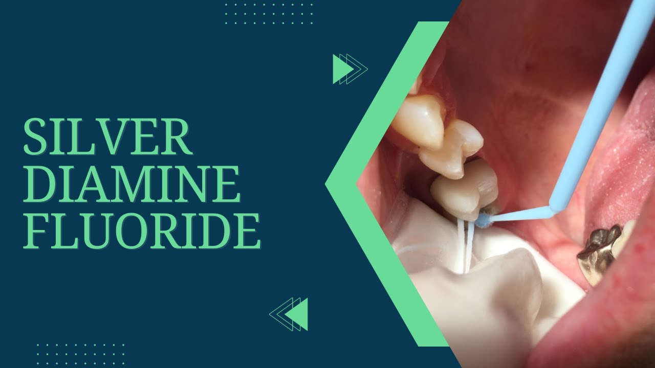 PEDIATRIC DENTISTRY | SILVER DIAMINE FLUORIDE | SDF
