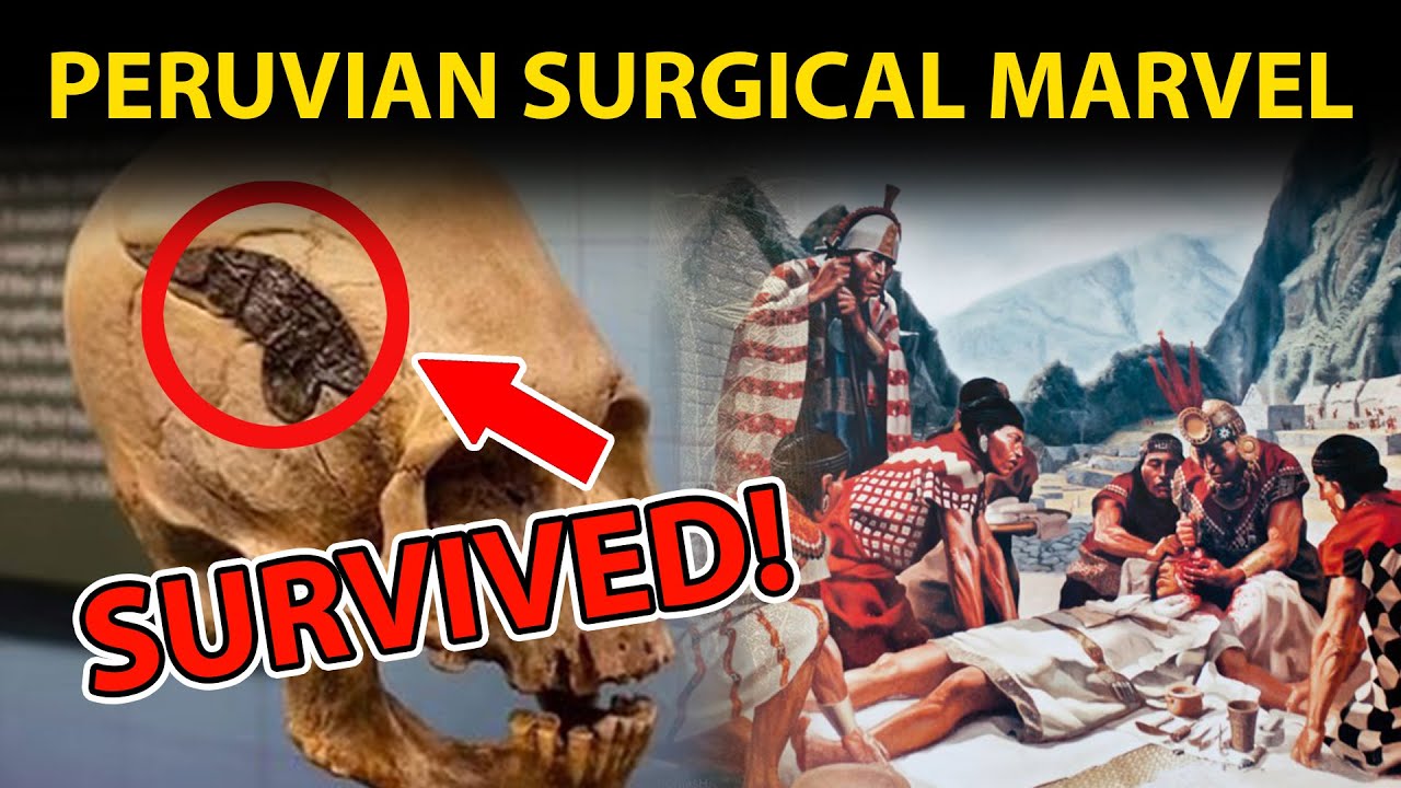 Unbelievable Survival: The Metal-Plated Skull of a Peruvian Warrior. The Secrets of Peruvian Surgery