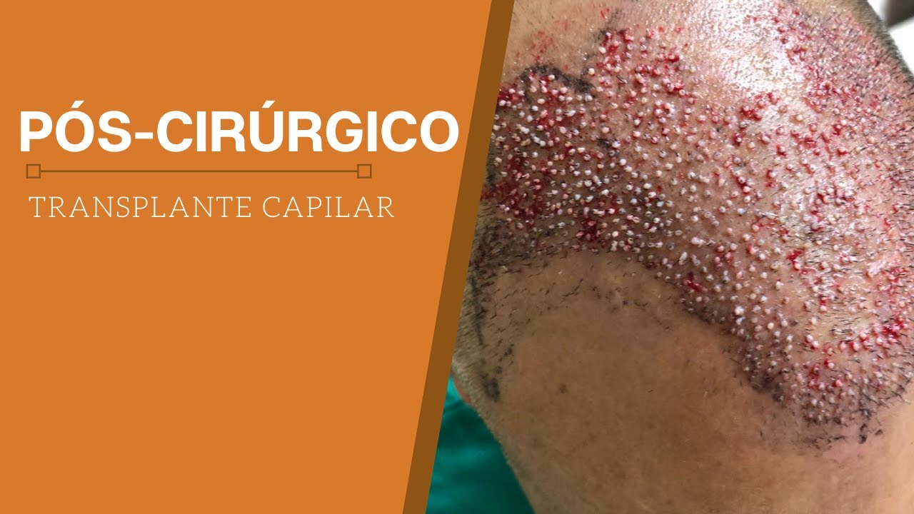 Como é o Pós-cirúrgico de transplante capilar fue?