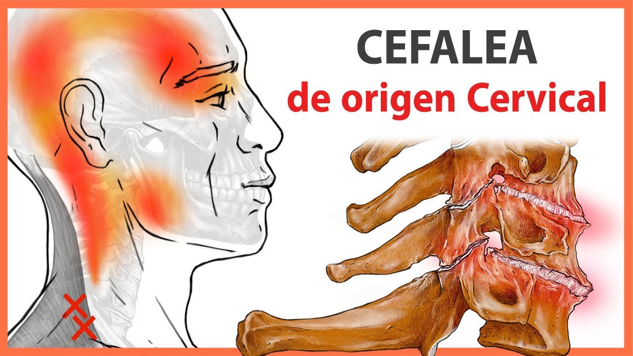 🛑  CLAVES de la CEFALEA 👉 Dolor de Cabeza de ORIGEN CERVICAL | ¿Qué es y cuáles son sus CAUSAS? 😳