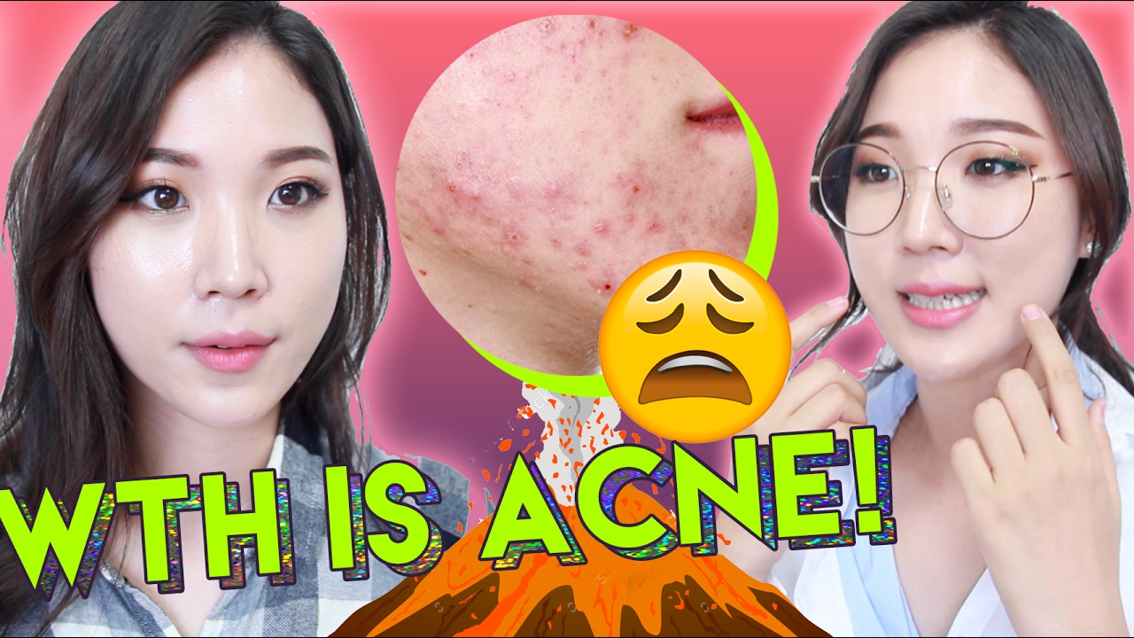😫 What Is Acne and How To Treat Acne with Skincare Products 🌴 Liah Yoo