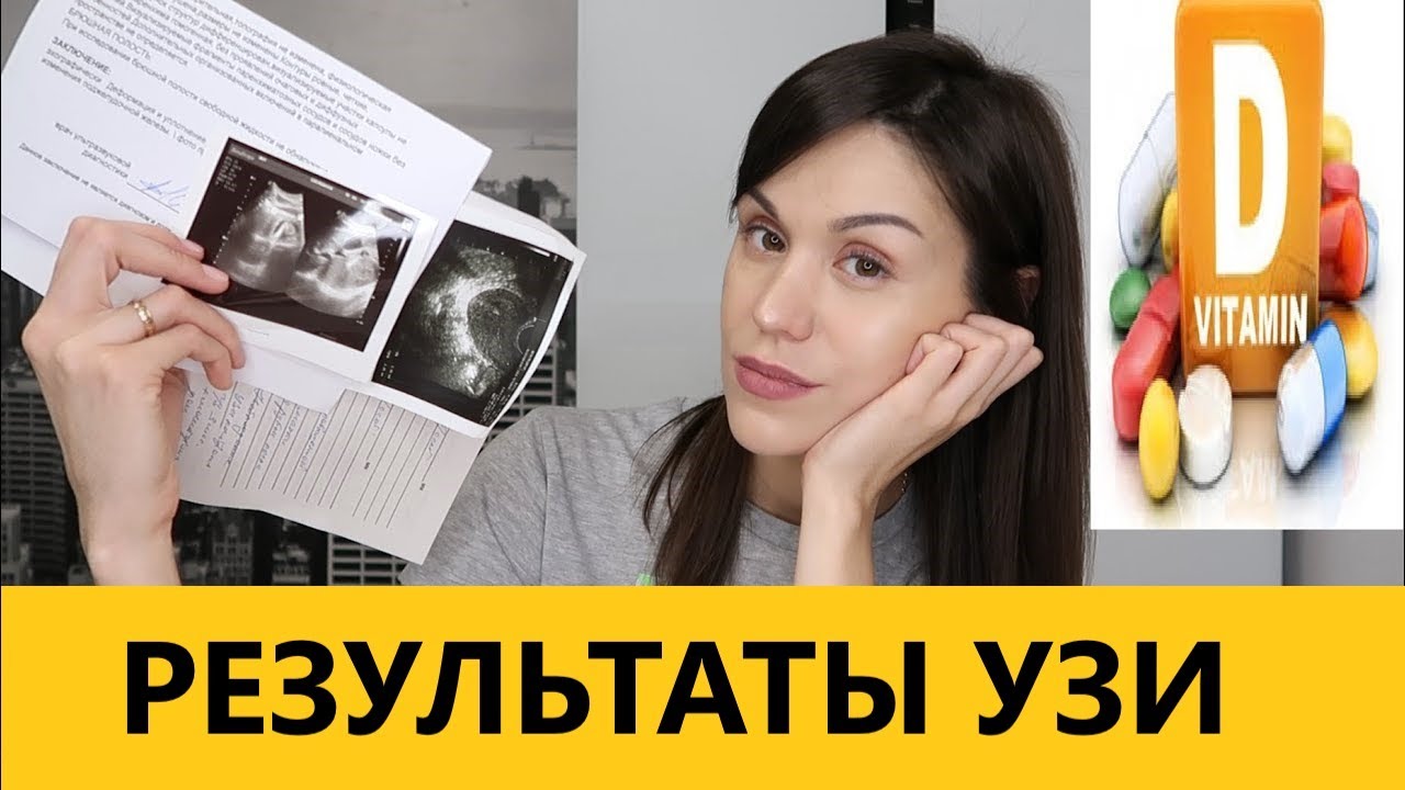 МОЯ ИСТОРИЯ/ ВИТАМИН Д / РЕЗУЛЬТАТЫ УЗИ / ПРОБЛЕМЫ С ПОДЖЕЛУДОЧНОЙ ЖЕЛЕЗОЙ / ПЛЮСЫ  ЛАПАРОСКОПИИ