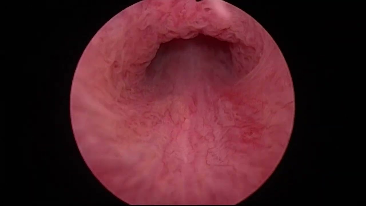 GLOMERULATIONS IN BLADDER PAIN SYNDROME