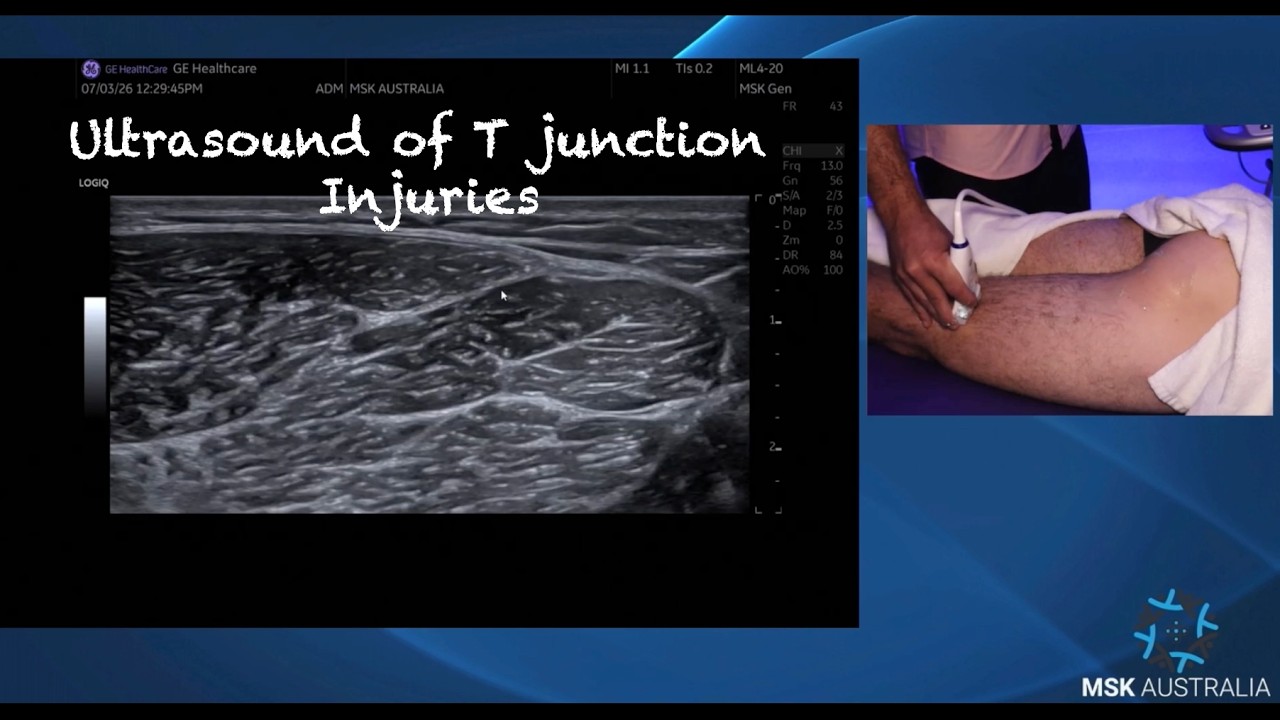 Ultrasound of T JUNCTION hamstring injuries