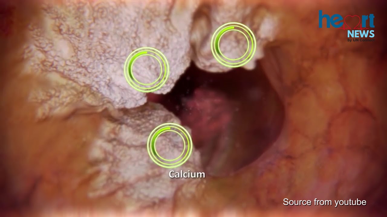 THE LATEST TECHNOLOGY IN CORONARY ANGIOGRAM AND PCI - DIAMONDBACK PROCEDURE