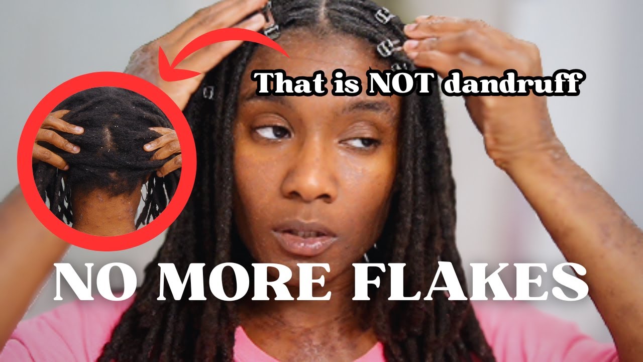 The ONLY Treatment You Need for DRY ITCHY SCALP ! | #eczema #locmaintenance