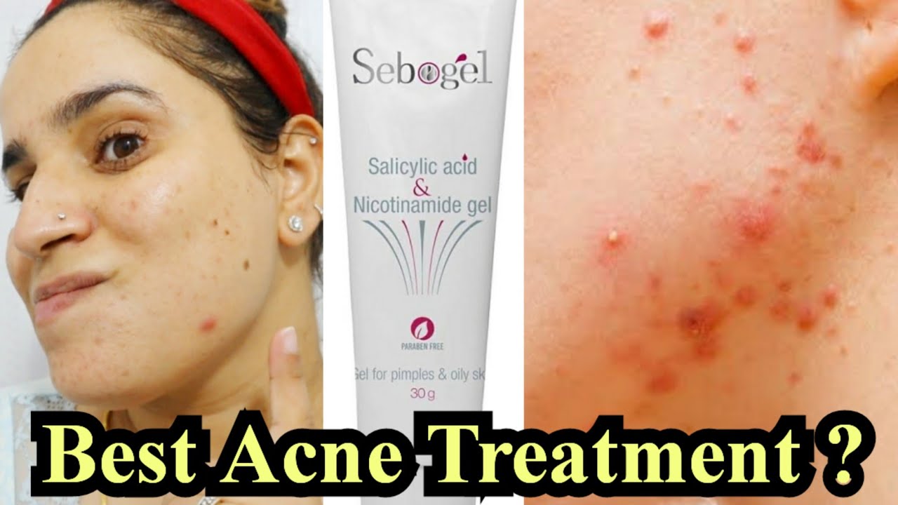 Sebogel Acne Gel Honest Review | Salicylic Acid + Niacinamide for Clear Skin