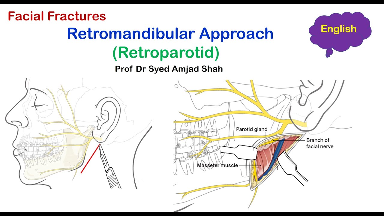 Retromandibular | Retroparotid approach | English | Oral & Maxillofacial Surgery | Syed Amjad Shah