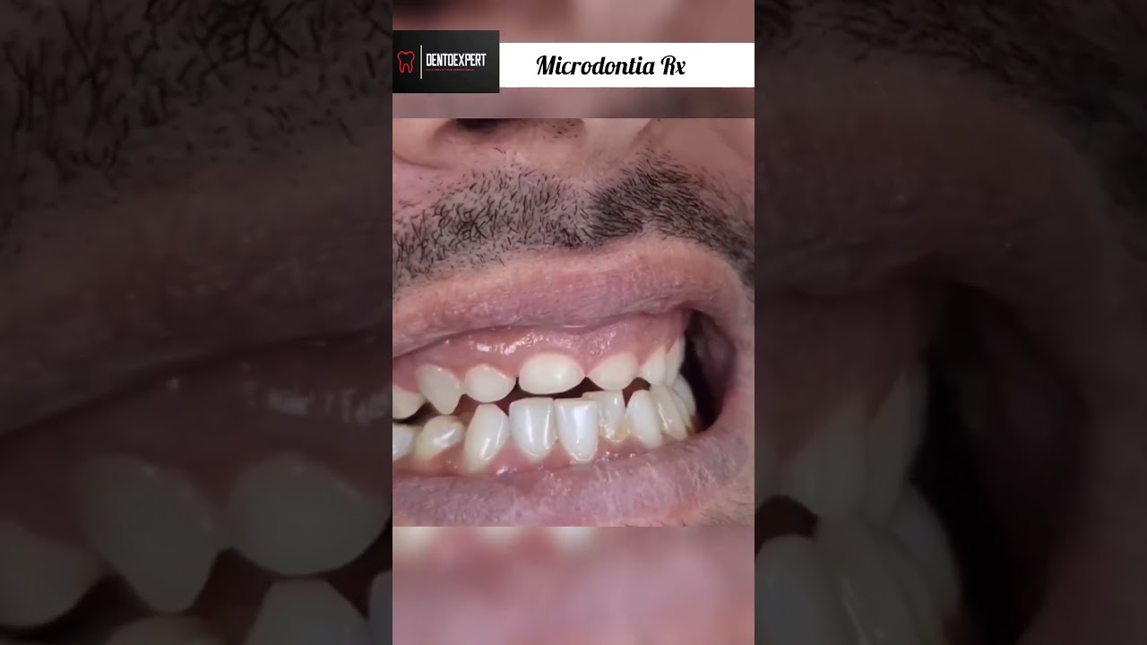 Rx - Microdontia | Small Tooth | Crown Lengthning Procedure 💯 #shorts #dentist #shortsfeed #viral 🔥