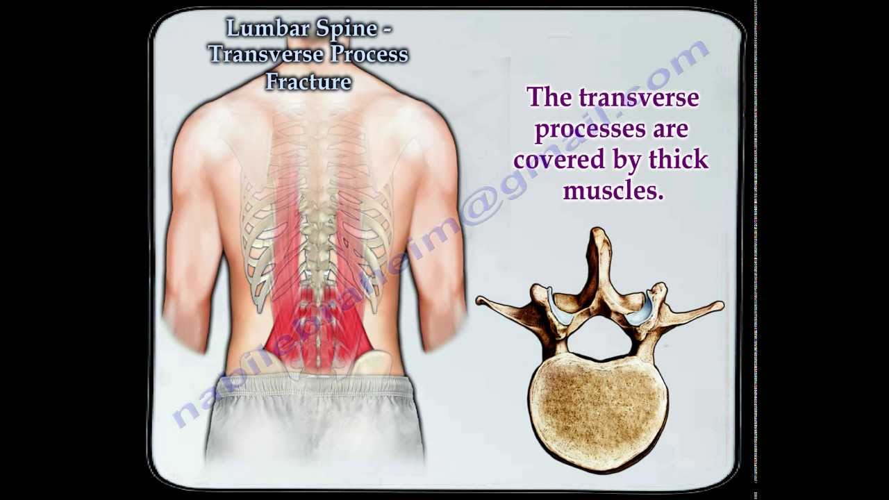 Lumbar Spine Transverse Process Fracture  - Everything You Need To Know - Dr. Nabil Ebraheim