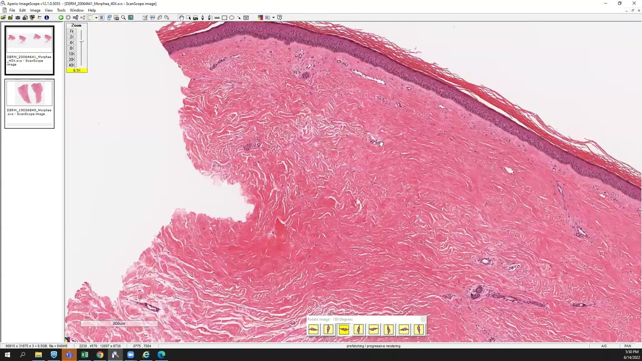 Morphea/scleroderma