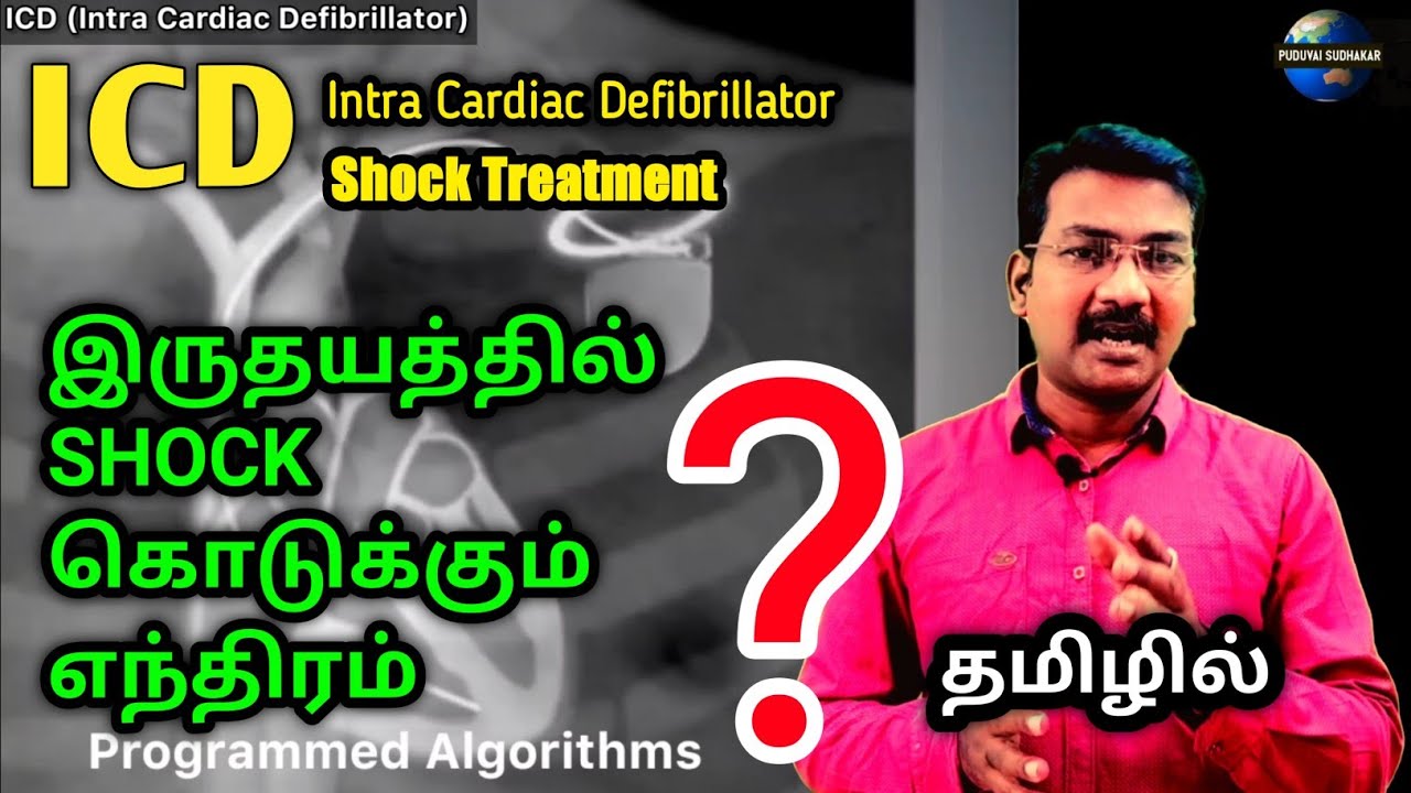 ICD in tamil | intra Cardiac Defibrillator  | arrhythmia treatment| defibrillation | ps tamil