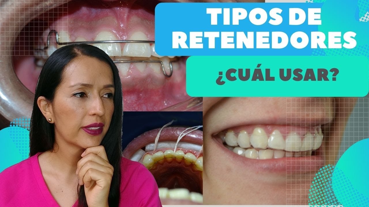 Tipos de retenedores en ortodoncia. ¿SE NECESITAN ?