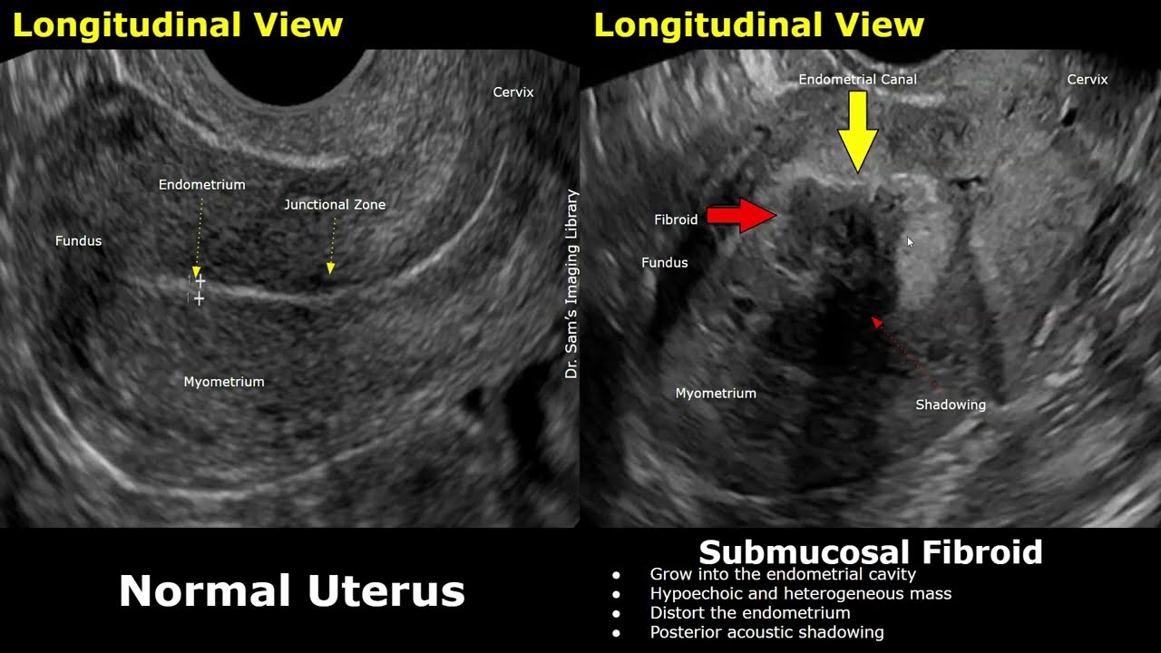 Uterus Ultrasound Normal Vs Submucosal Fibroid Cases | FIGO Classification Of Leiomyomas USG