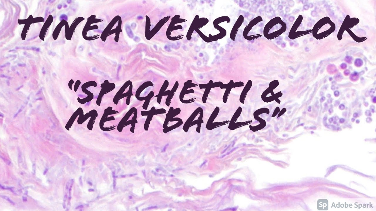 Pityriasis Versicolor/Tinea Versicolor 101: Malassezia/Pityrosporum Fungus Skin Infection