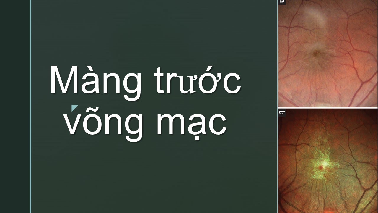 VLOG 42# - Màng trước võng mạc là bệnh gì? What is epiretinal membrane?