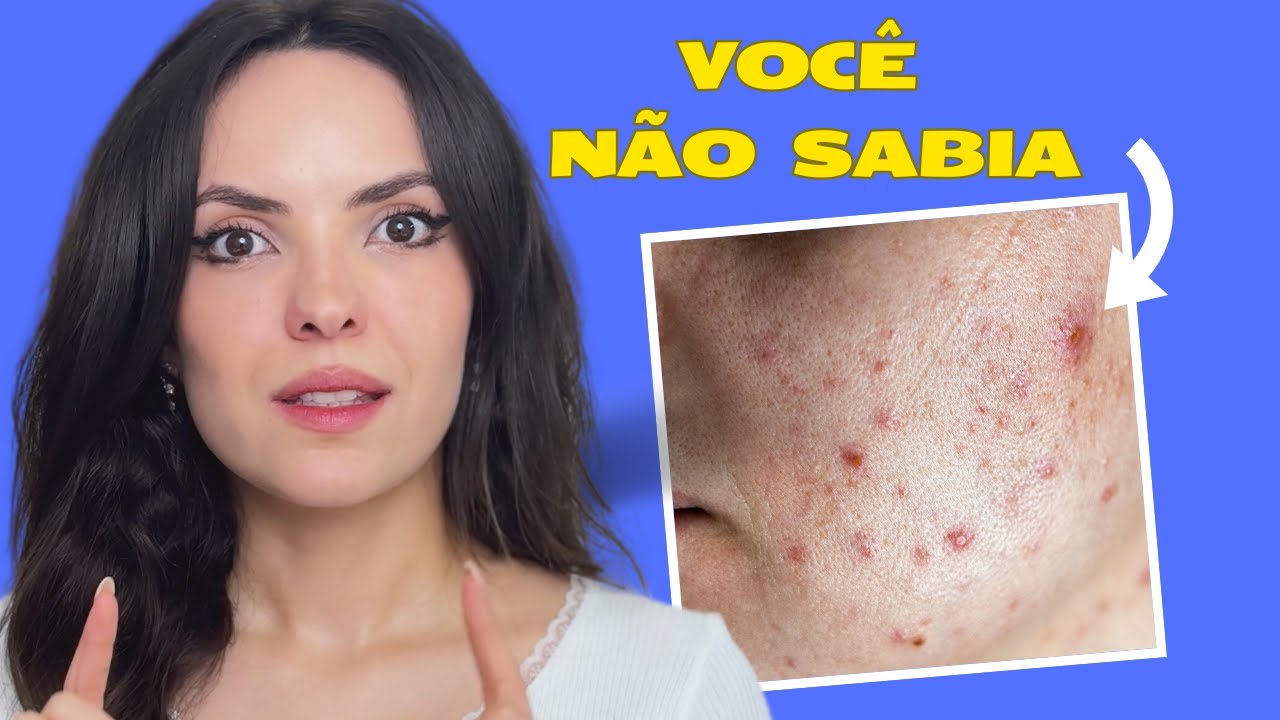 O que Realmente Funciona para Acne, Cravos e Espinhas