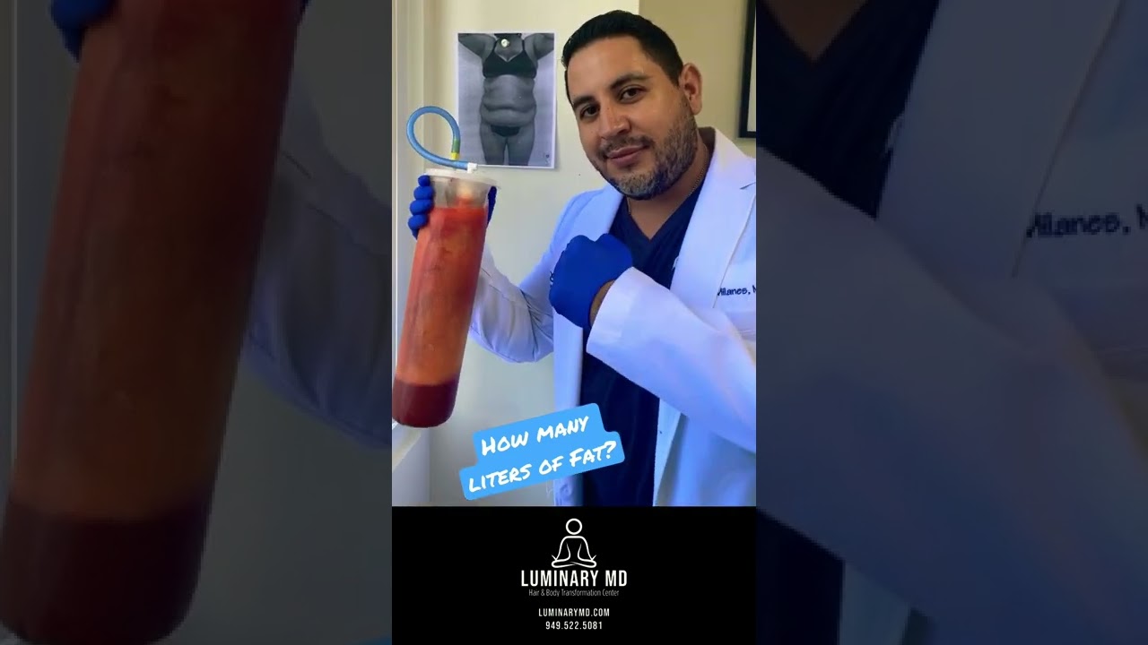 Guess how much fat I&rsquo;m holding?Another great day of Liposuction in Orange County