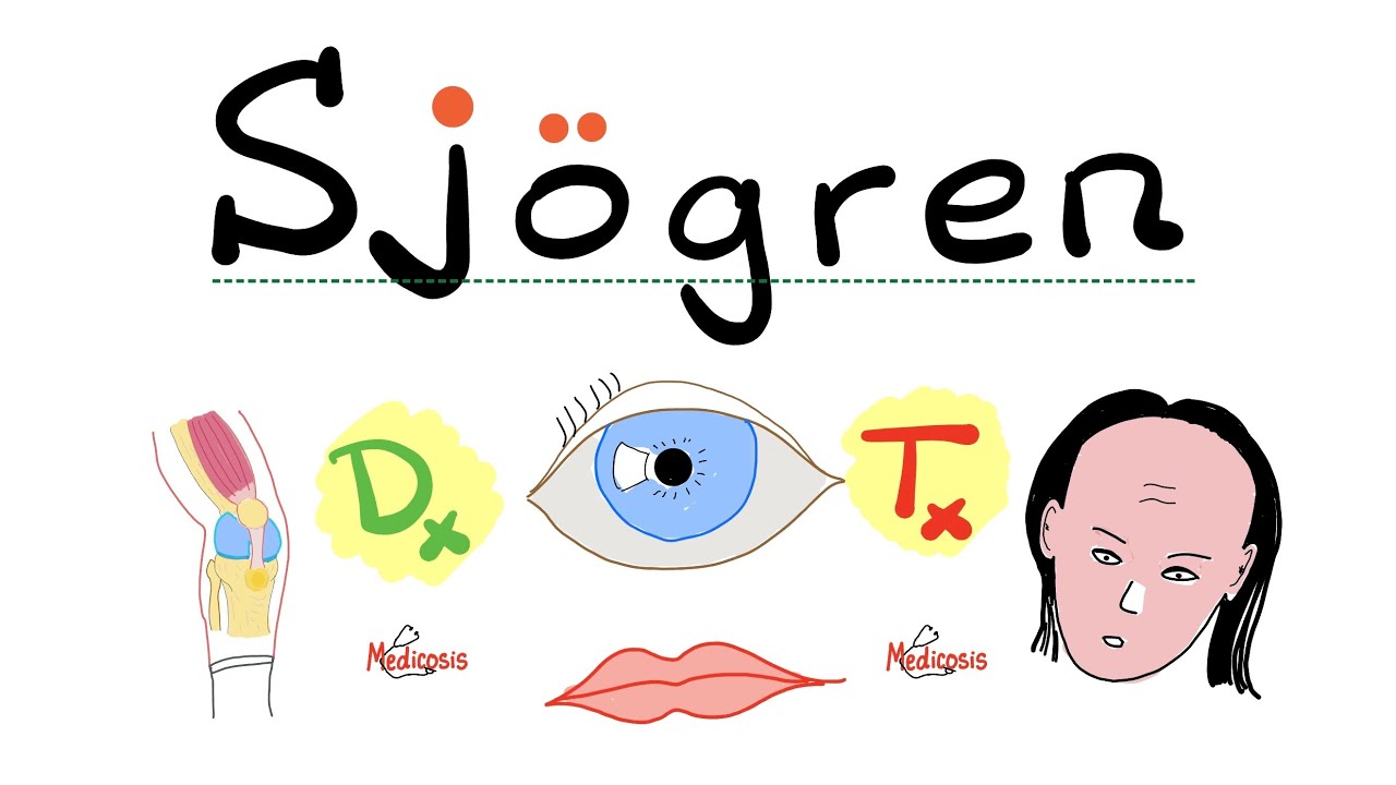 Sjögren Syndrome - Diagnosis and Management - Xerostomia, Xerophthalmia, Arthritis - Rheumatology