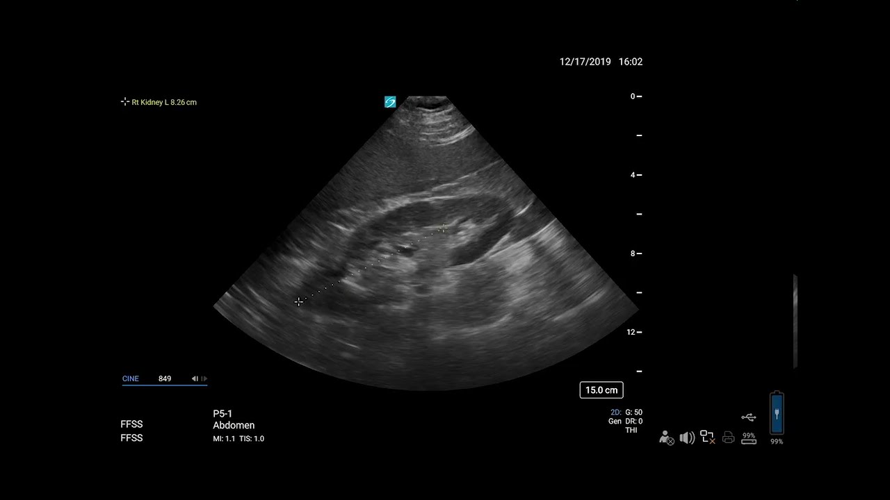 Sonosite PX Help Video - Taking Measurements