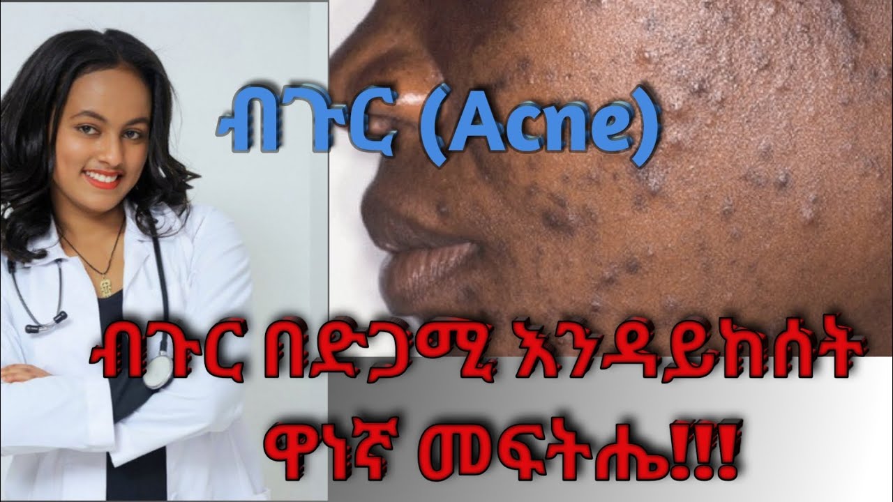 ብጉር (Acne) መንስኤዎች እና መፍትሔዎች #health#acne#antiacne#ብጉር#skincare#habesha#healthconsultant#beauty