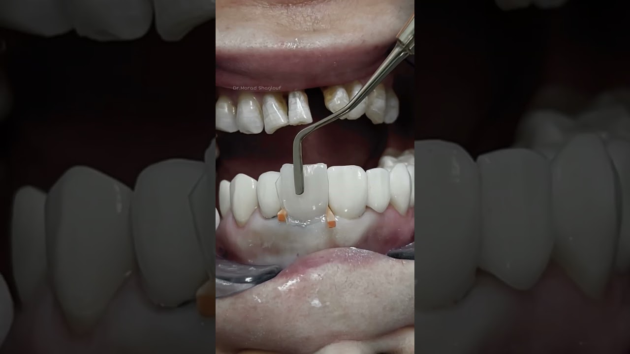 Composite veneer for discolored tooth #dental