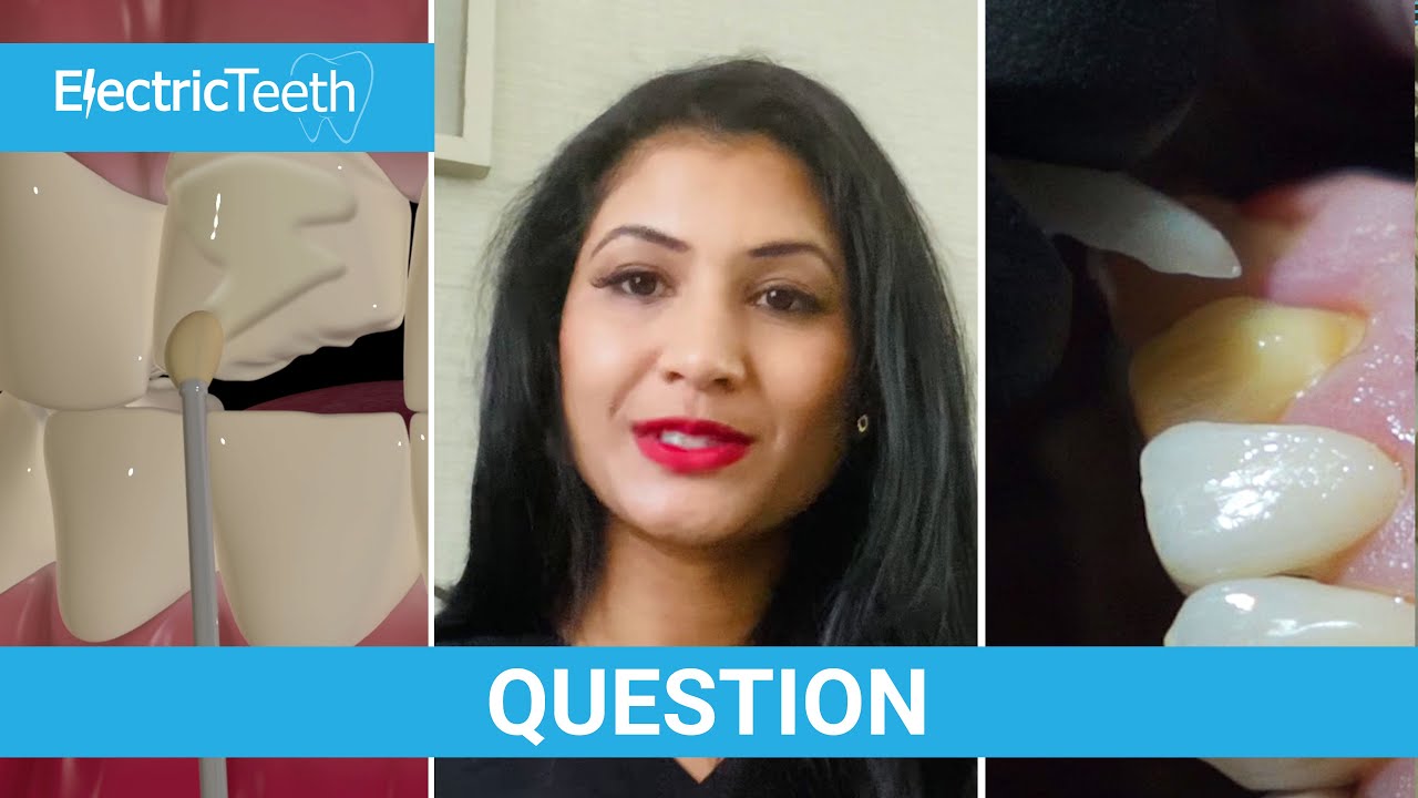 How long do veneers last?
