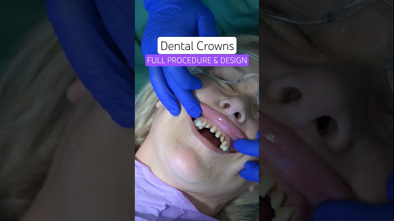 Step-by Step-Dental Crown Procedure  (FULL PROCEDURE & DESIGN)  #dentalcrowns #crowns
