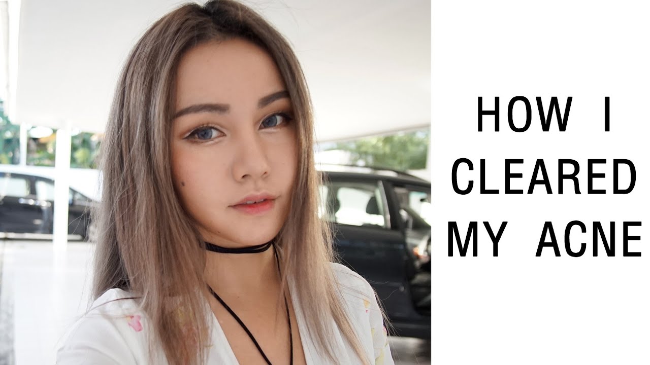 Tips For Clear Skin | How I Got Rid of My Acne | My Acne Story