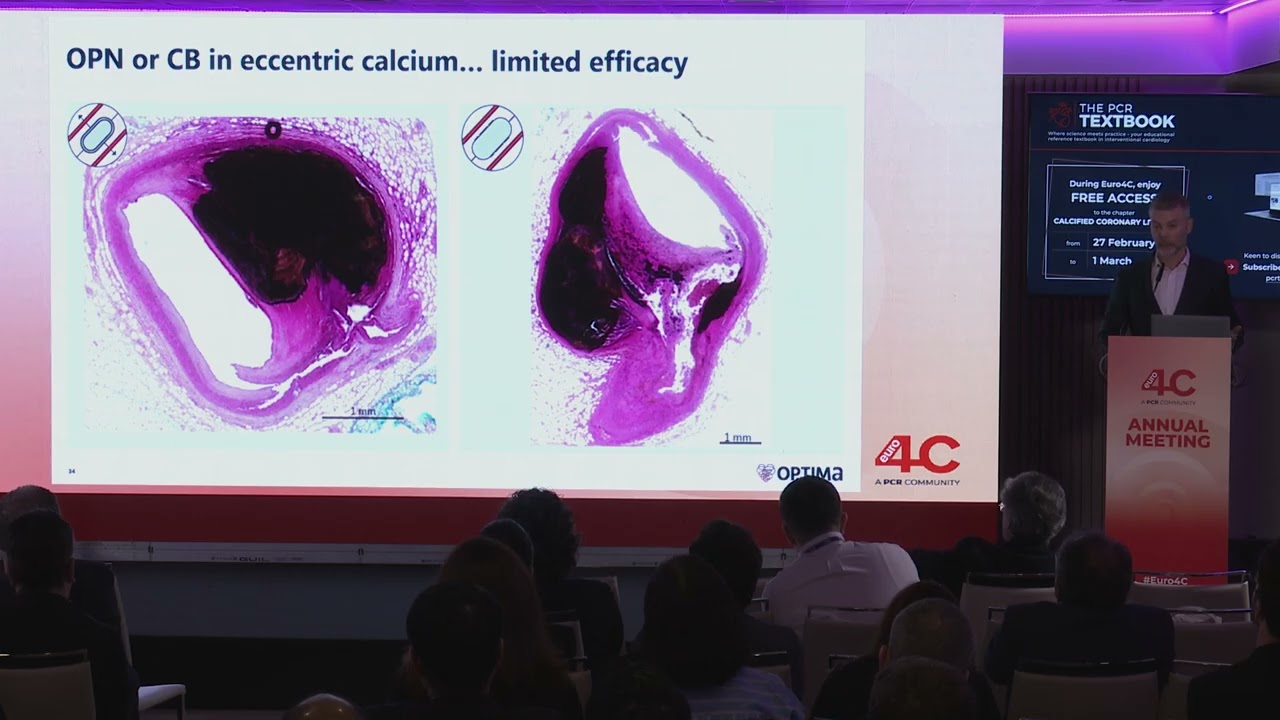 Introducing next era of coronary intravascular lithotripsy: aero-volution in calcium modification