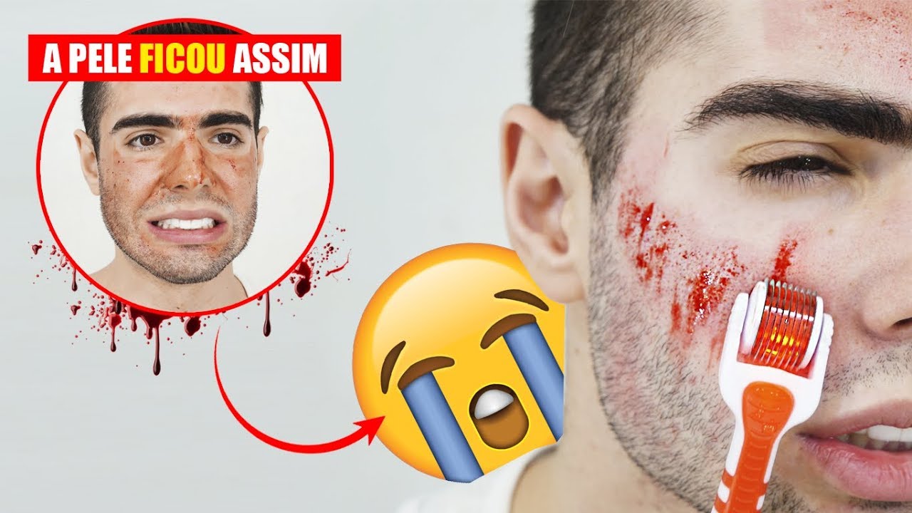 O RESULTADO DO MICROAGULHAMENTO EM CASA