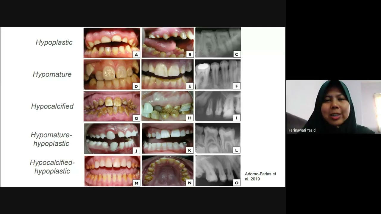 Revisiting Amelogenesis Imperfecta