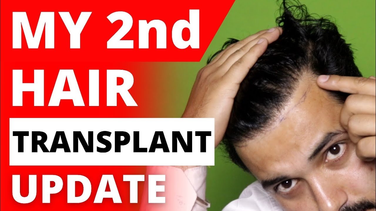 My Second Hair Transplant