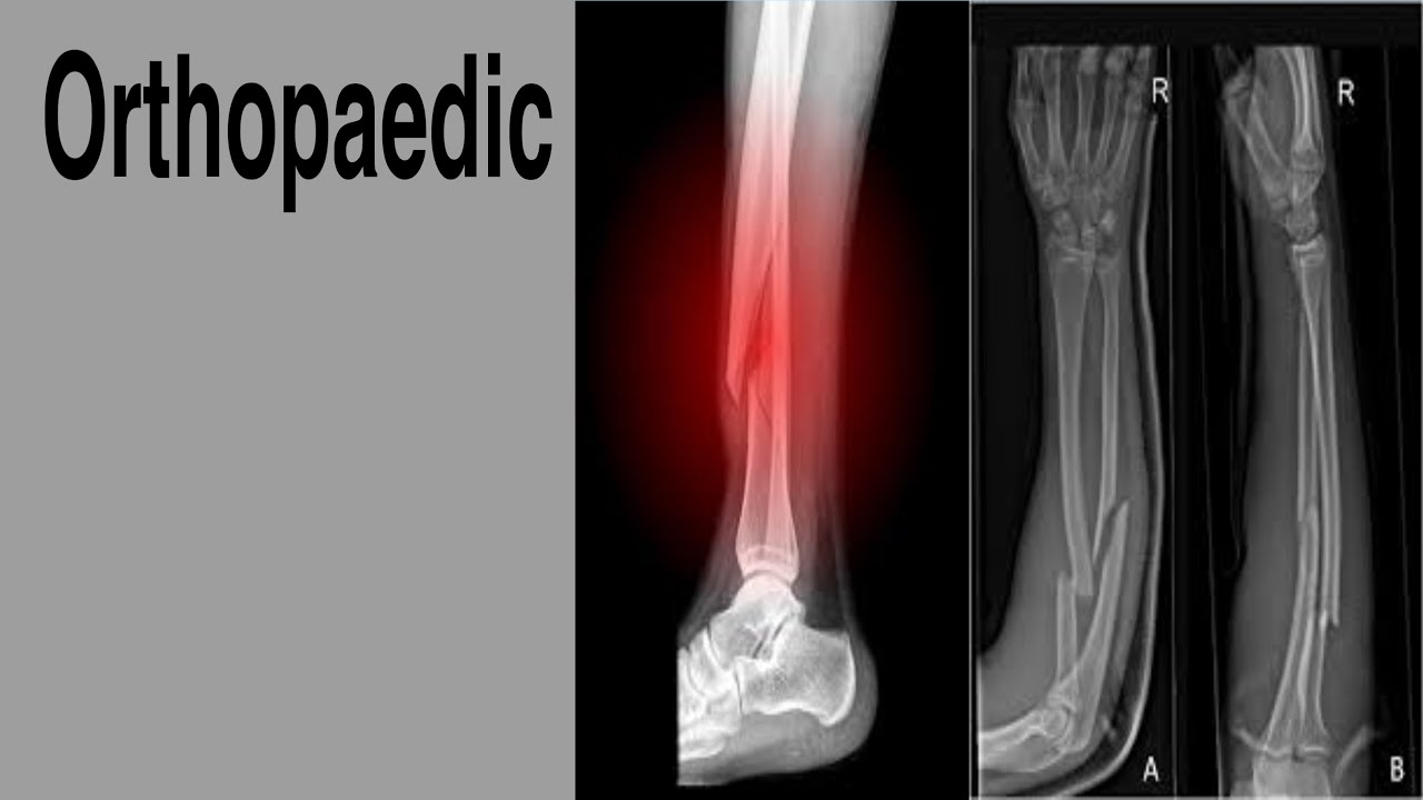 Surgery // orthopaedic (1) // schem of fracture
