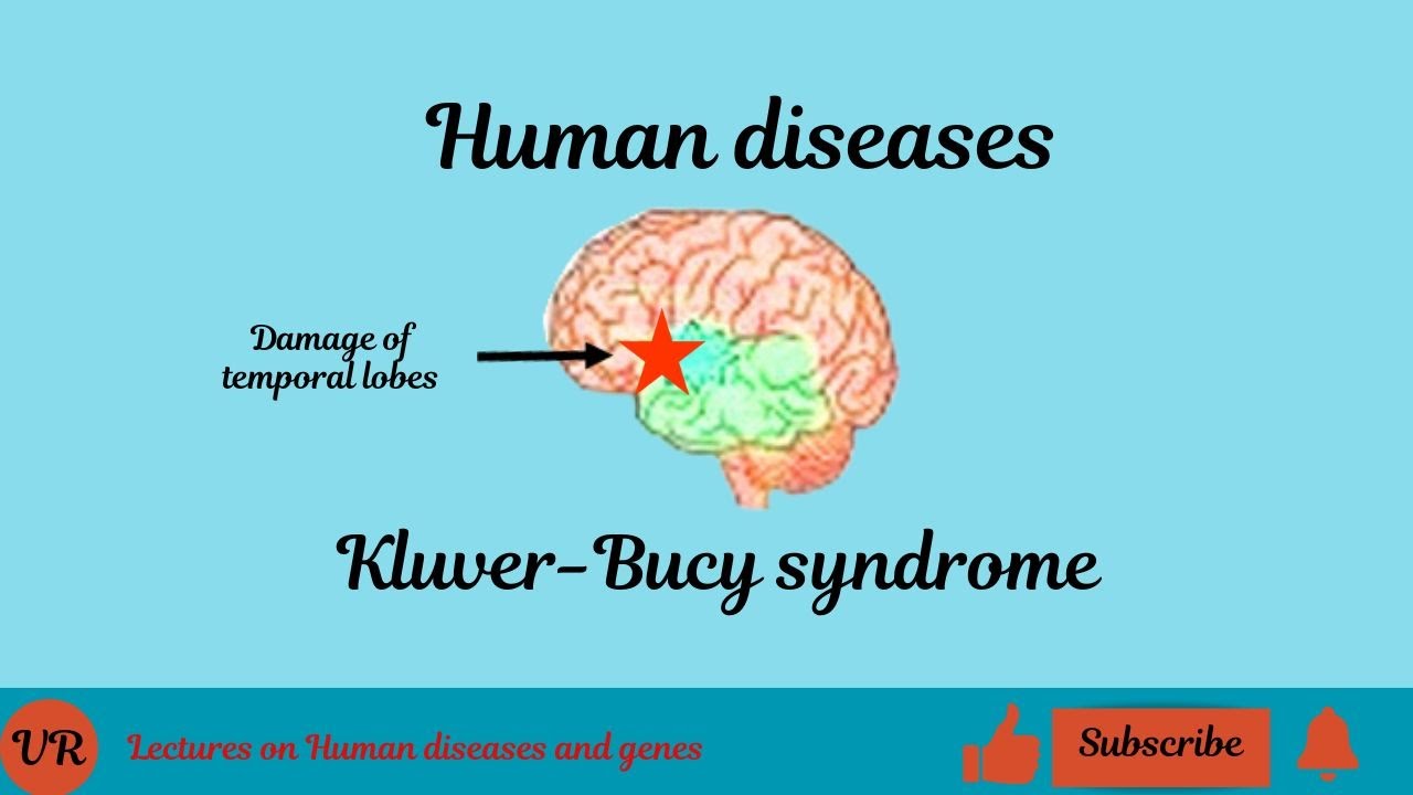 What is Kluver-Bucy Syndrome ?