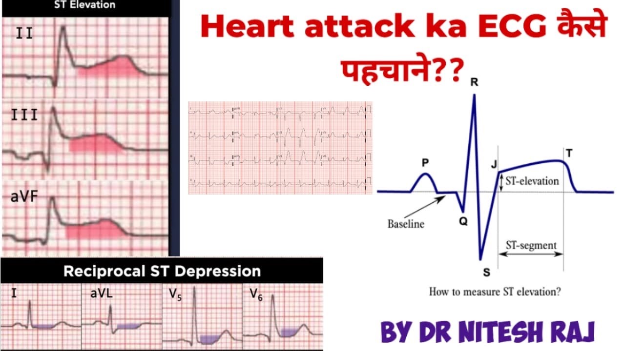 ECG ST Segment elevation and depression in Hindi #drniteshraj