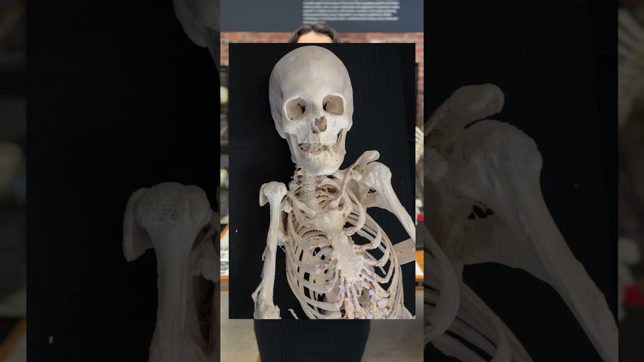 Fibrodysplasia ossificans progressiva (FOP)
