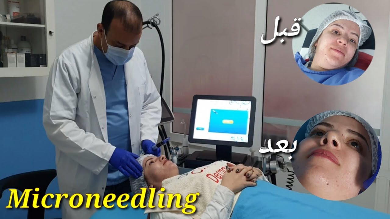 تجربتي مع Microneedling😍العلاج الذي أنقد بشرتي🤔أجيو تعرفو أشنو هو والدور ديالو⁉️ الحل لبشرة مثالية👸