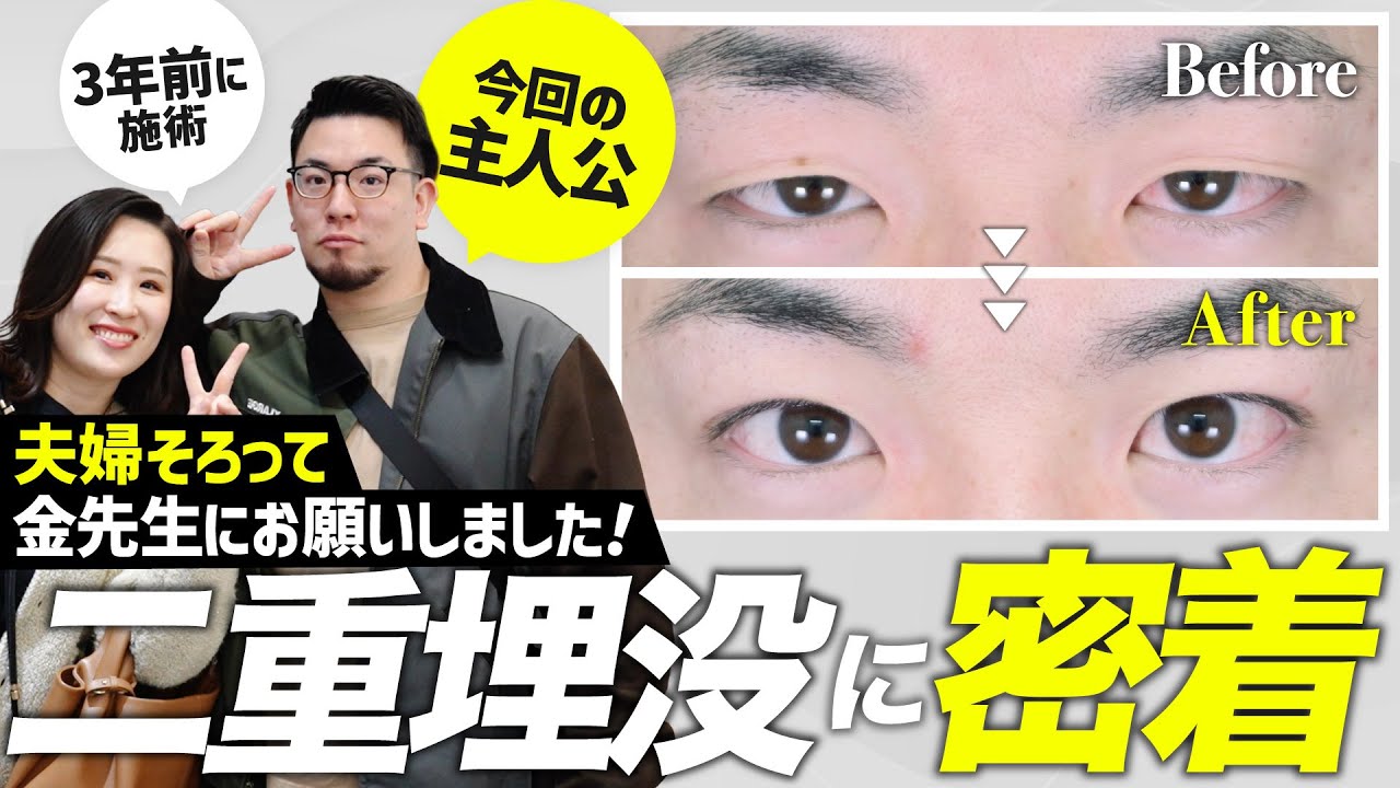 夫婦で二重整形に密着！かっこよくするだけじゃない！キム先生のスゴ腕二重埋没のダウンタイム経過！【クイックコスメティーク】