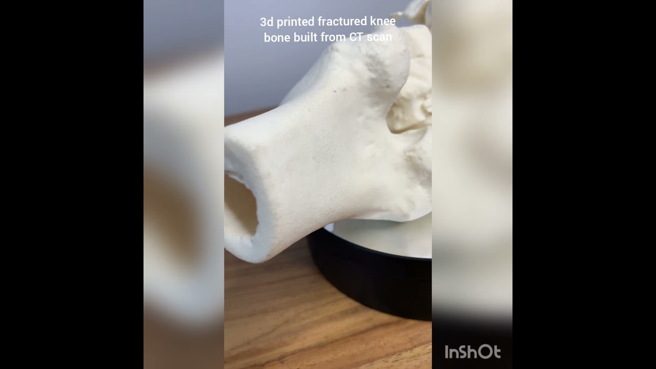 3D Printed Fractured Knee Bone Built From CT Scan