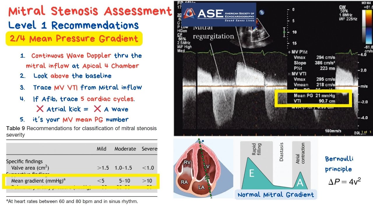 Mean Pressure Gradient - mitral stenosis severity assessment with example - echo review